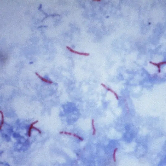 Ziehl-Neelsen (ZN) Stain For Acid-Fast Bacillus (AFB)